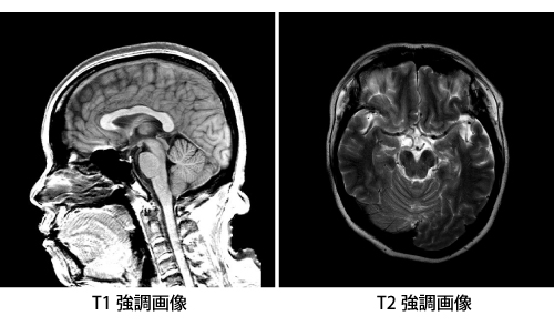 髄膜炎とは｜八重洲クリニック 脳神経外科